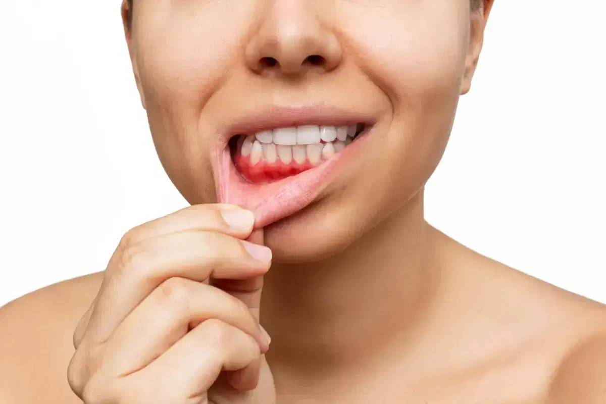 Qué es la enfermedad periodontal
